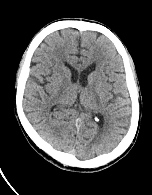 Acute superior cerebellar artery territory infarct (Radiopaedia 84104-99359 Axial non-contrast 34).jpg