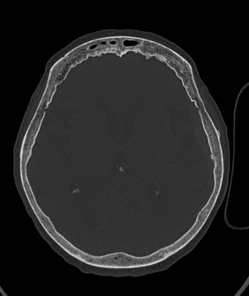 Acute traumatic subdural hematoma (Radiopaedia 82921-97257 Axial bone window 56).jpg