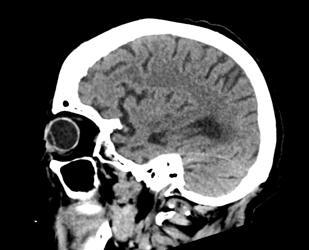 File:Acute traumatic subdural hematoma (Radiopaedia 82921-97257 Sagittal non-contrast 25).jpg