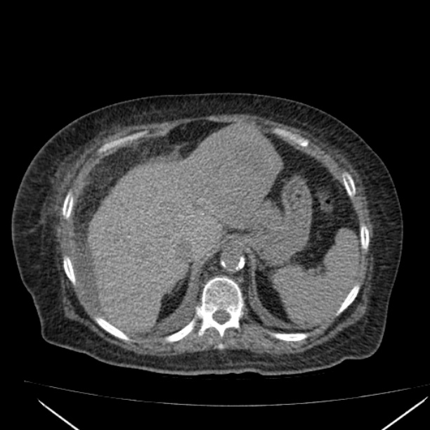 Acute tubular necrosis (Radiopaedia 28077-28334 Axial non-contrast 16).jpg