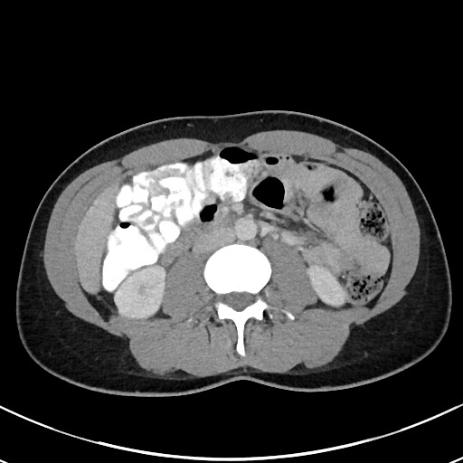 File:Acute uncomplicated appendicitis (Radiopaedia 61374-69304 Axial C+ portal venous phase 56).jpg