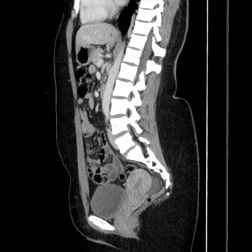 File:Acute uncomplicated appendicitis (Radiopaedia 73704-84499 Sagittal C+ portal venous phase 117).jpg