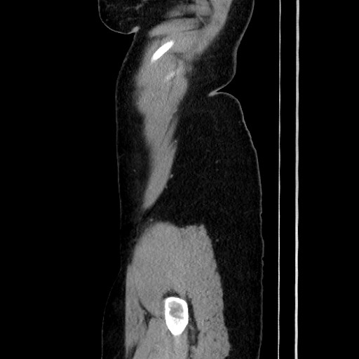 File:Acute uncomplicated appendicitis (Radiopaedia 73704-84499 Sagittal C+ portal venous phase 45).jpg
