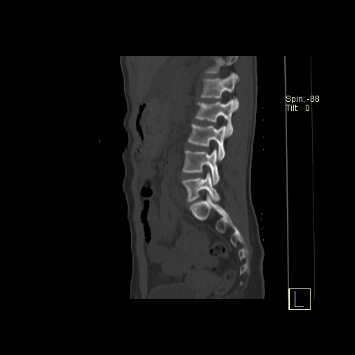 File:Acute vertebral compression fracture (Radiopaedia 63832-72559 Sagittal bone window 4).jpg