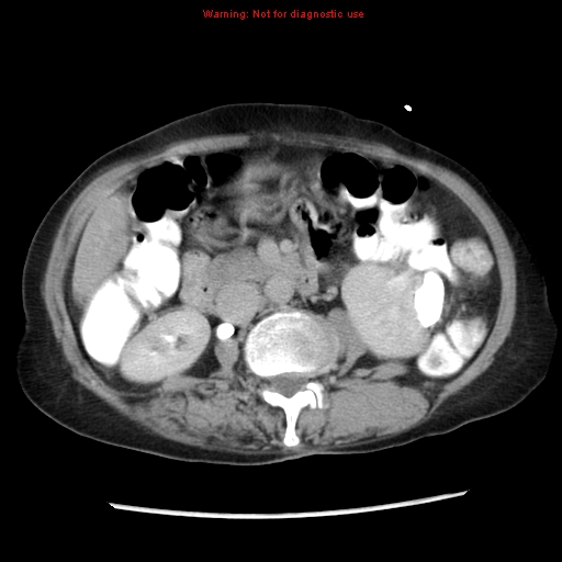 File:Adenocarcinoma of the colon (Radiopaedia 8191-9039 Axial renal excretory phase 20).jpg