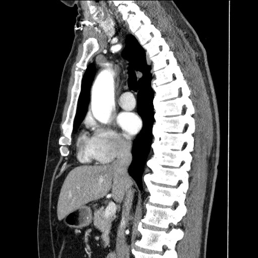 Adenocarcinoma of the lung (Radiopaedia 59871-67325 Sagittal C+ arterial phase 47).jpg