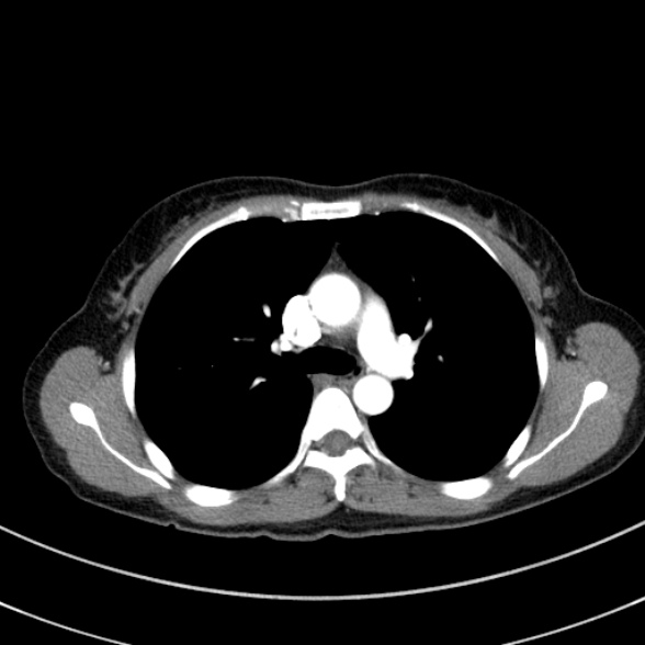 Adenocystic carcinoma of the trachea (Radiopaedia 47677-52525 Axial C+ arterial phase 46).jpg