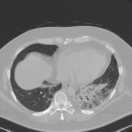 Adenoid cystic carcinoma of the trachea (Radiopaedia 49042-54137 Axial lung window 256).jpg