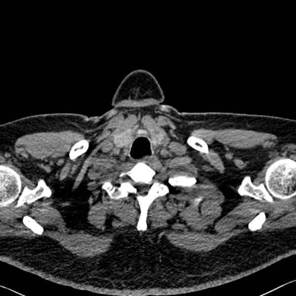 Adenoid cystic carcinoma of the trachea (Radiopaedia 49042-54137 Axial non-contrast 6).jpg
