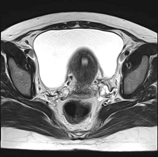 File:Adenomyosis - ovarian endometriomas (Radiopaedia 67031-76350 Axial T2 17).jpg
