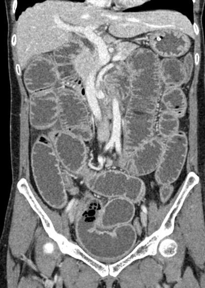 File:Adhesional small bowel obstruction (Radiopaedia 48397-53305 Coronal C+ portal venous phase 155).jpg