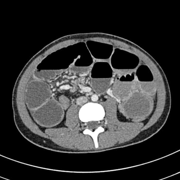 Adhesional small bowel obstruction (Radiopaedia 52107-57980 Axial C+ portal venous phase 65).jpg