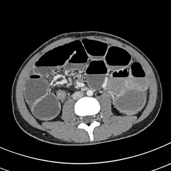 File:Adhesional small bowel obstruction (Radiopaedia 52107-57980 Axial C+ portal venous phase 66).jpg