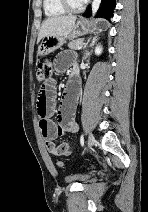 Adhesional small bowel obstruction (Radiopaedia 58900-66131 Sagittal C+ portal venous phase 150).jpg