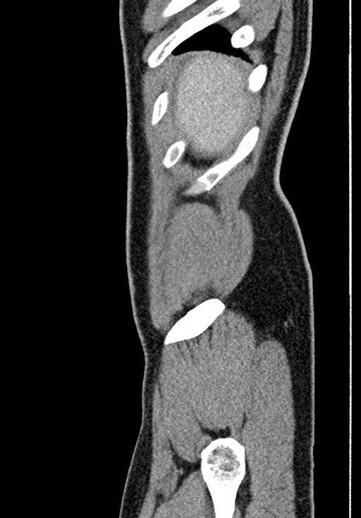 Adhesional small bowel obstruction (Radiopaedia 58900-66131 Sagittal C+ portal venous phase 20).jpg