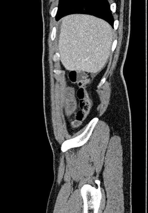Adhesional small bowel obstruction (Radiopaedia 58900-66131 Sagittal C+ portal venous phase 33).jpg