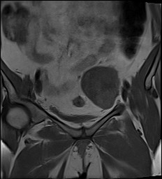 File:Adnexal multilocular cyst (O-RADS US 3- O-RADS MRI 3) (Radiopaedia 87426-103754 Coronal 11).jpg