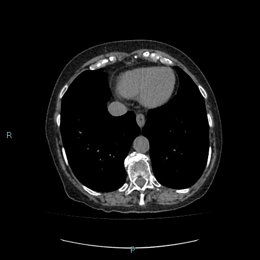 File:Adrenal collision tumor (ACT) (Radiopaedia 48462-53379 Axial non-contrast 3).jpg