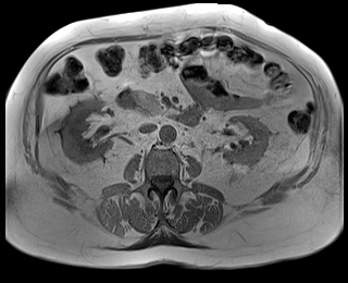 File:Adrenal cortical carcinoma (Radiopaedia 64017-72770 Axial T1 in-phase 46).jpg