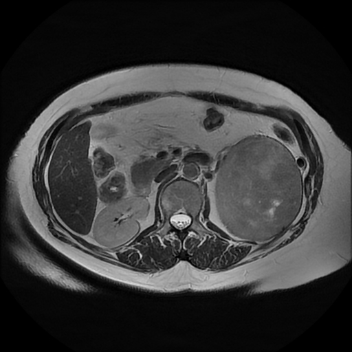 File:Adrenal cortical carcinoma (Radiopaedia 70906-81116 Axial T2 19).jpg