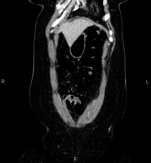 Adrenal cortical carcinoma (Radiopaedia 84882-100379 Coronal C+ portal venous phase 6).jpg