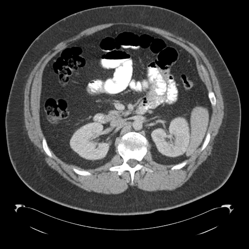 Adrenal cyst (Radiopaedia 45625-49776 Axial C+ portal venous phase 39).png