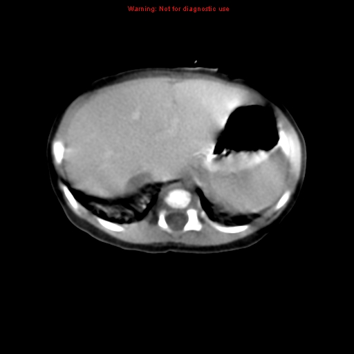 File:Adrenal hemorrhage (Radiopaedia 9390-10077 Axial C+ portal venous phase 1).jpg