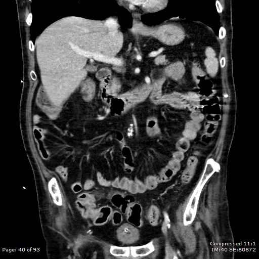File:Adrenal metastasis (Radiopaedia 78425-91079 Sagittal C+ portal venous phase 27).jpg