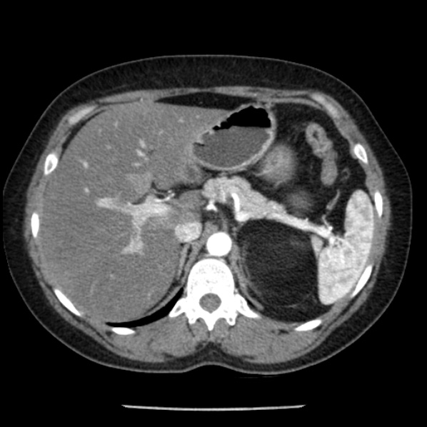 Adrenal myelolipoma (Radiopaedia 43401-46759 Axial C+ arterial phase 26).jpg