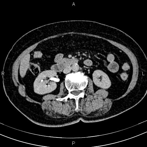 Adrenal myelolipoma (Radiopaedia 82742-96986 Axial renal excretory phase 72).jpg