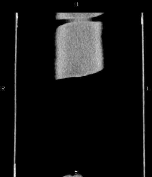 Adrenal myelolipoma (Radiopaedia 82742-96986 Coronal renal cortical phase 82).jpg