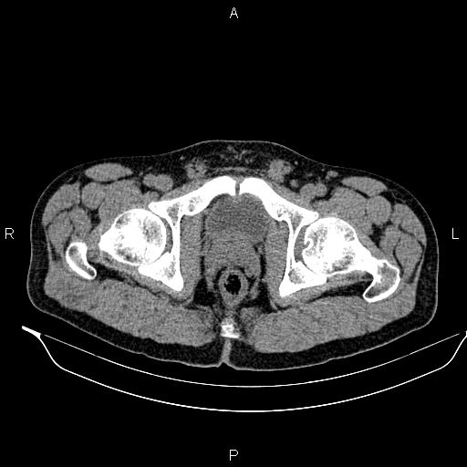 Adrenal myelolipoma (Radiopaedia 87794-104246 Axial non-contrast 105).jpg