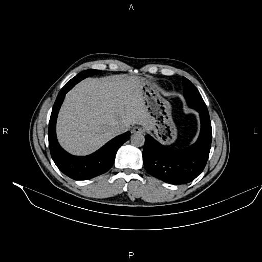 File:Adrenal myelolipoma (Radiopaedia 87794-104246 Axial non-contrast 16).jpg
