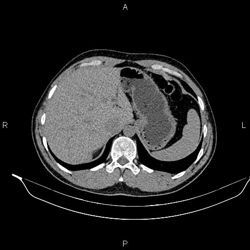 Adrenal myelolipoma (Radiopaedia 87794-104246 Axial non-contrast 22).jpg