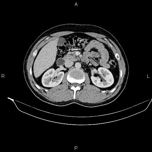 Adrenal myelolipoma (Radiopaedia 87794-104246 Axial renal cortical phase 42).jpg