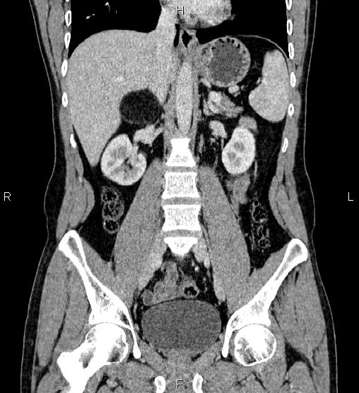 Adrenal myelolipoma (Radiopaedia 87794-104246 Coronal renal cortical phase 35).jpg