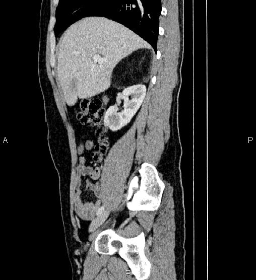 Adrenal myelolipoma (Radiopaedia 87794-104246 Sagittal renal cortical phase 29).jpg