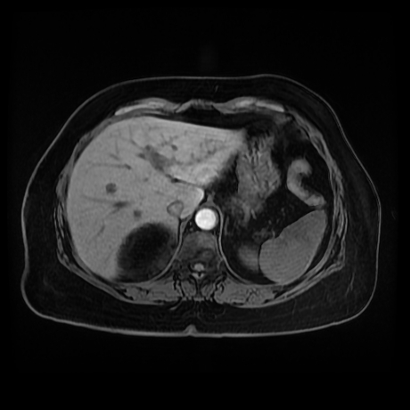 Adrenal myelolipoma - MRI (Radiopaedia 83249-97646 Axial T1 fat sat 15).jpg