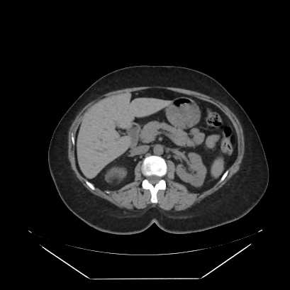 File:Adrenal myelolipoma - MRI (Radiopaedia 83249-97647 Axial non-contrast 47).jpg