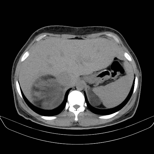 Adrenal myelolipoma - bilateral (Radiopaedia 74805-85810 Axial non-contrast 14).jpg