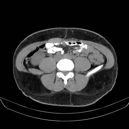 File:Adrenal myelolipoma - bilateral (Radiopaedia 74805-85810 Axial non-contrast 50).jpg