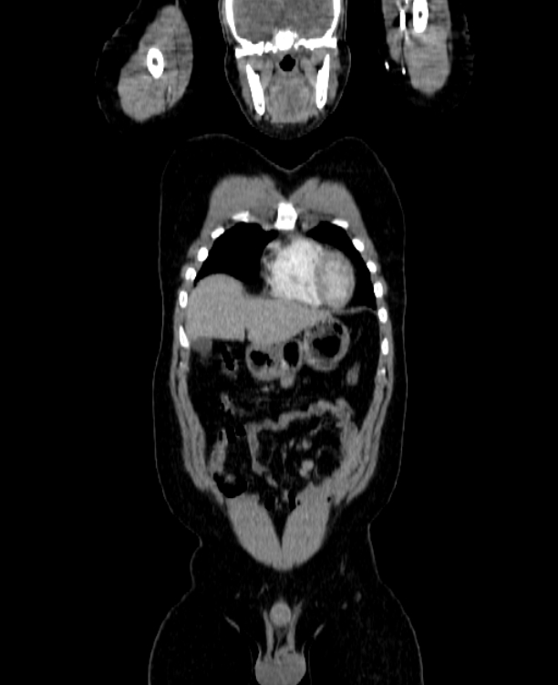 Adrenocortical carcinoma (Radiopaedia 80134-93438 Coronal C+ portal venous phase 40).jpg