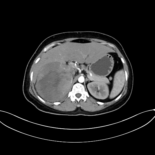 File:Adrenocortical carcinoma (Radiopaedia 87281-103569 Axial C+ arterial phase 28).jpg