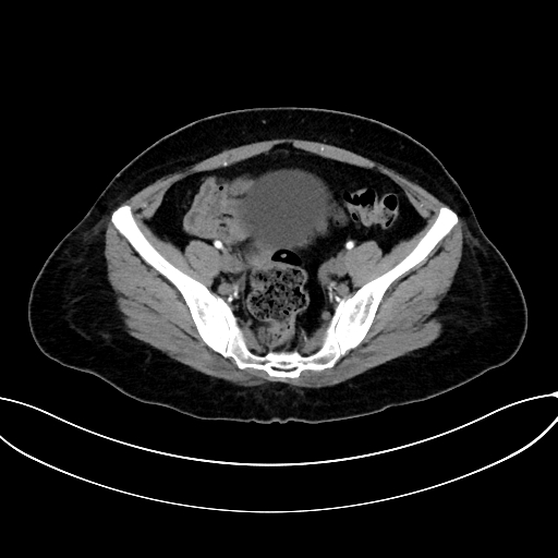 Adrenocortical carcinoma (Radiopaedia 87281-103569 Axial C+ arterial phase 70).jpg