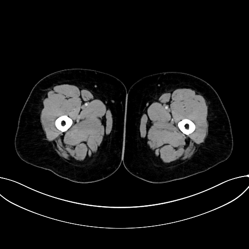 Adrenocortical carcinoma (Radiopaedia 87281-103569 Axial C+ portal venous phase 106).jpg