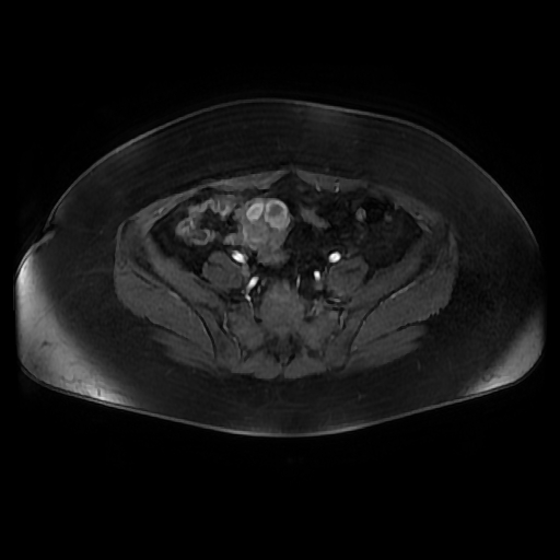 File:Adult granulosa cell tumor of the ovary (Radiopaedia 64991-73953 axial-T1 Fat sat post-contrast dynamic 19).jpg