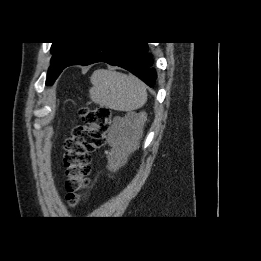 Adult polycystic kidney disease (Radiopaedia 59075-66368 Sagittal non-contrast 83).jpg