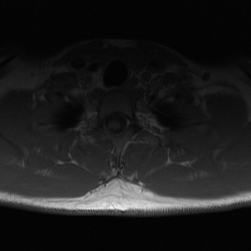 File:Aggressive vertebral hemangioma (Radiopaedia 39937-42404 Axial T1 38).png