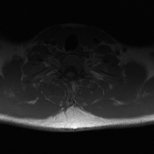 File:Aggressive vertebral hemangioma (Radiopaedia 39937-42404 Axial T1 39).png
