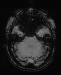 File:Alzheimer's disease- with Gerstmann syndrome and dressing apraxia (Radiopaedia 54882-61150 Axial SWI 9).png